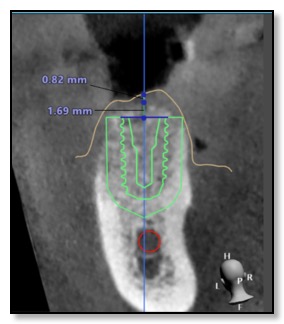 Dental Implant Placement Surgical Guide Design